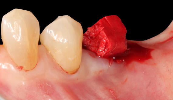 Revolutionary Dental Bone Grafting Material Receives Medical  Clearance in the U.S., Europe, and Canada