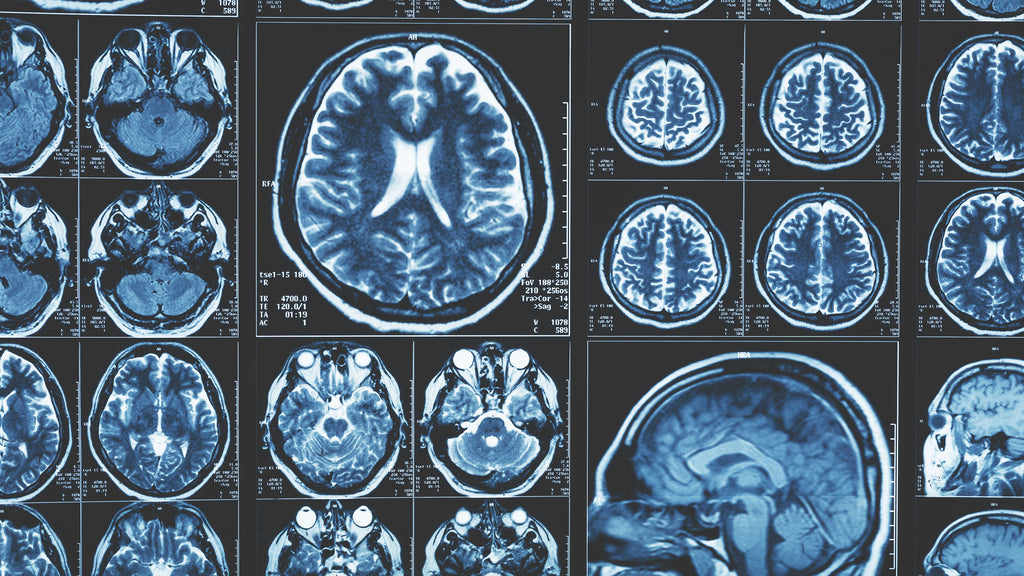 Two Parallel Israeli Studies Make Advances Toward Combating GBM Brain Tumors