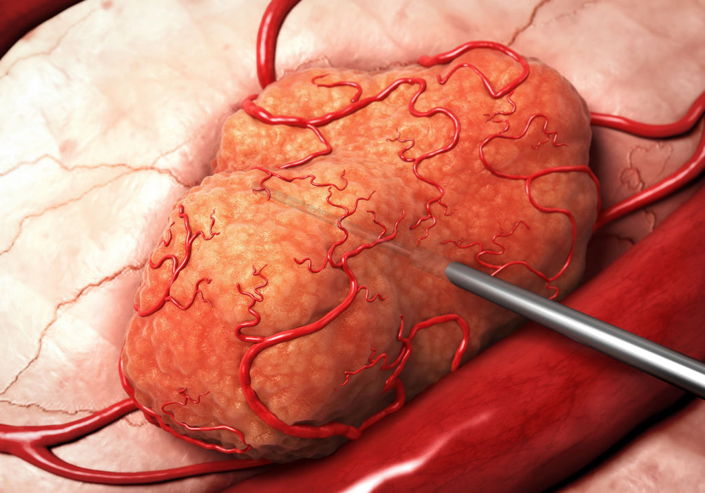 Alpha DaRT Hits the Bullseye in Delivering Radiation to Cancer Cells
